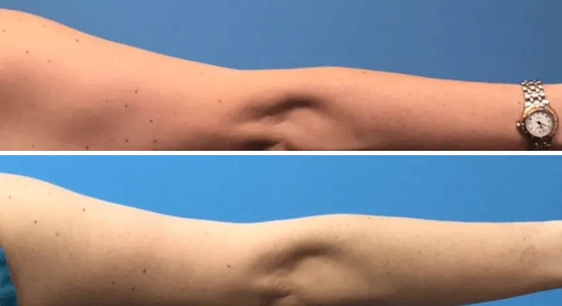 Before and after arm lift: woman's arms from the back