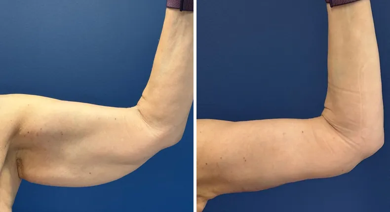 Before and after arm lift: patient's arms from the right side