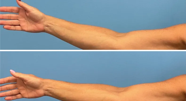 Before and after arm lift: patient's arms from the left side