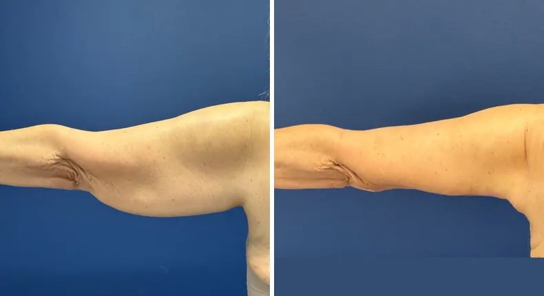 Before and after arm lift: patient's arms from the left side