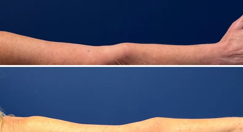 Before and after arm lift: patient's arms