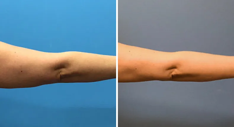 Before and after arm lift: woman's arms from the back
