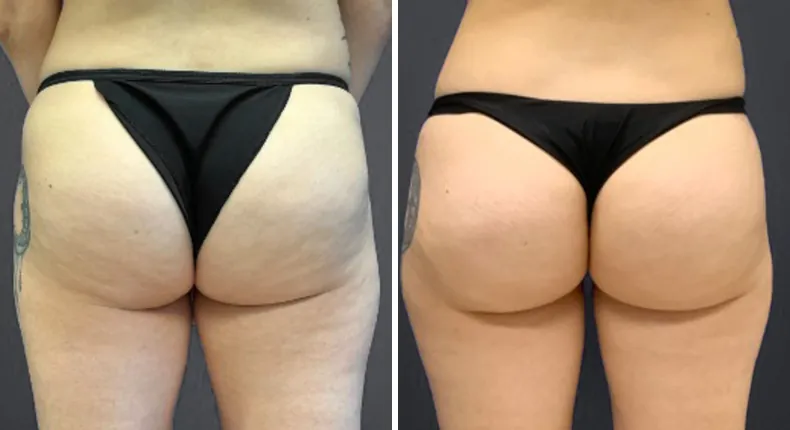 Before and after avéli (cellulite): patient's face