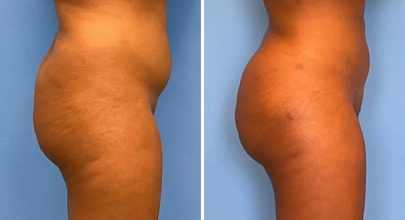 Before and after brazilian butt lift (bbl): patient's buttocks and hips from the right side
