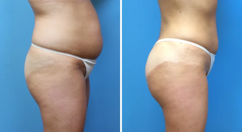 Before and after brazilian butt lift (bbl): patient's buttocks and hips from the right side