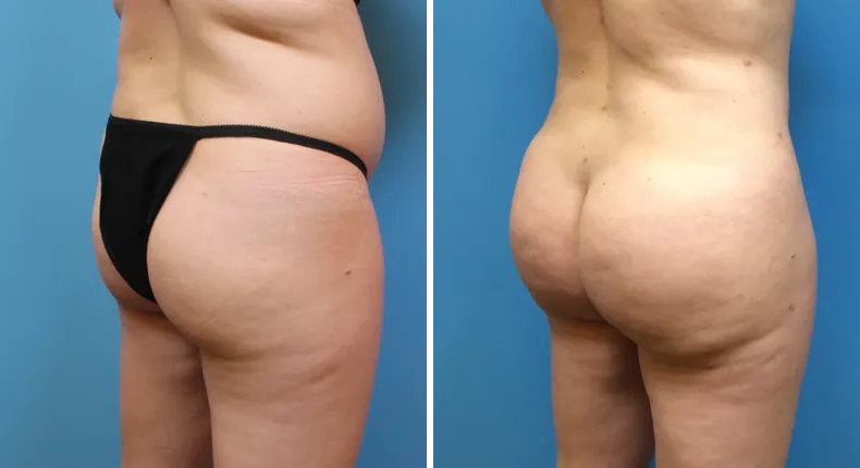 Before and after brazilian butt lift (bbl): patient's buttocks and hips at a right angle