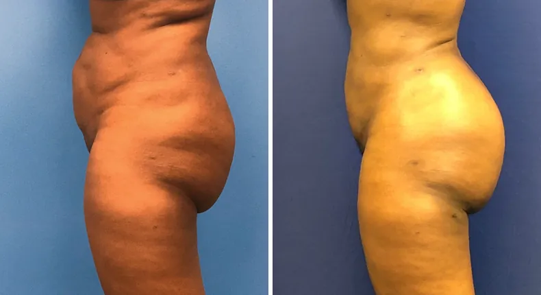 Before and after brazilian butt lift (bbl): patient's buttocks and hips from the left side
