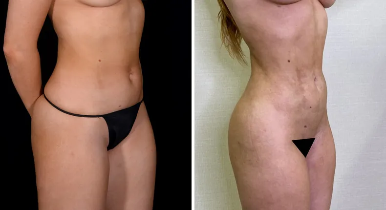Before and after brazilian butt lift (bbl): patient's buttocks and hips at a right angle, with liposuction