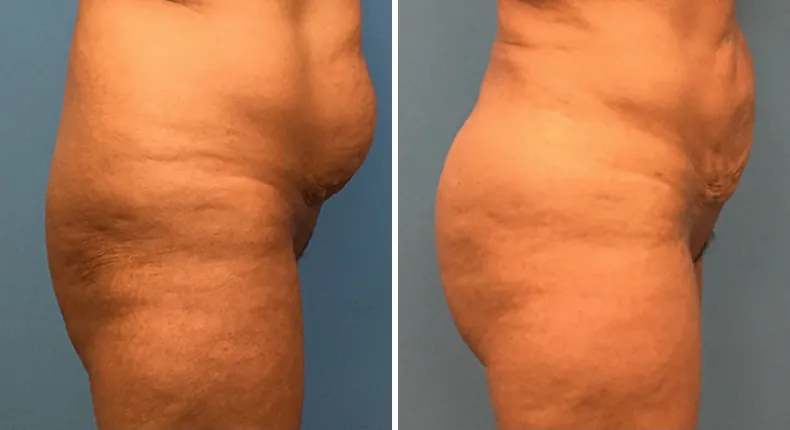 Before and after brazilian butt lift (bbl): patient's buttocks and hips from the right side