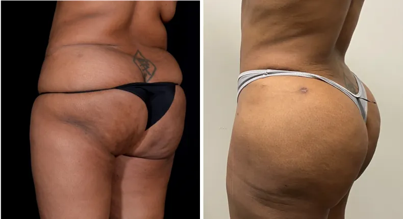 Before and after brazilian butt lift (bbl): patient's buttocks and hips at a left angle