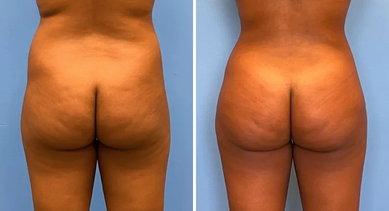 Before and after brazilian butt lift (bbl): patient's buttocks and hips