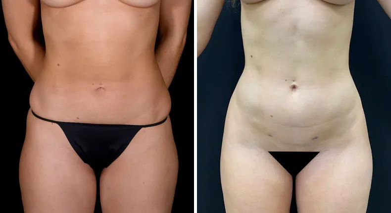 Before and after brazilian butt lift (bbl): patient's buttocks and hips from the front, with liposuction