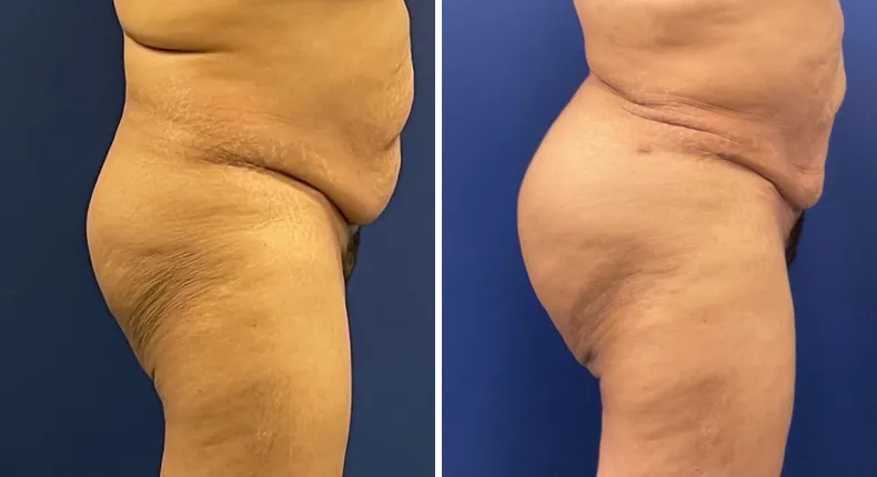 Before and after brazilian butt lift (bbl): woman's buttocks and hips from the right side