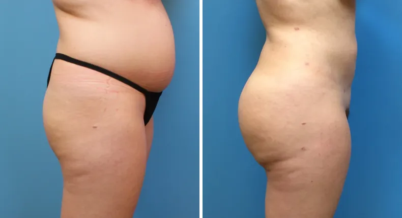Before and after brazilian butt lift (bbl): patient's buttocks and hips from the right side