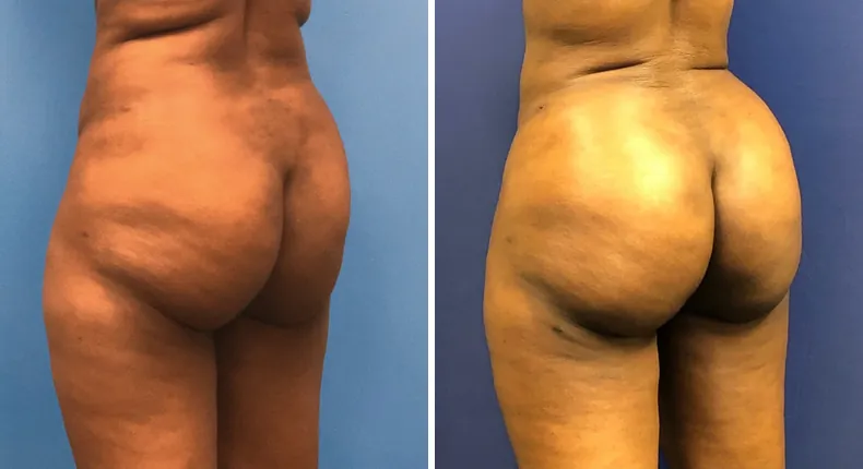 Before and after brazilian butt lift (bbl): patient's buttocks and hips at a left angle