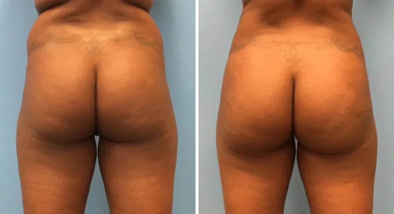 Before and after brazilian butt lift (bbl): woman's buttocks and hips from the back