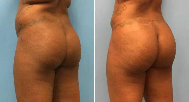 Before and after brazilian butt lift (bbl): woman's buttocks and hips at a left angle