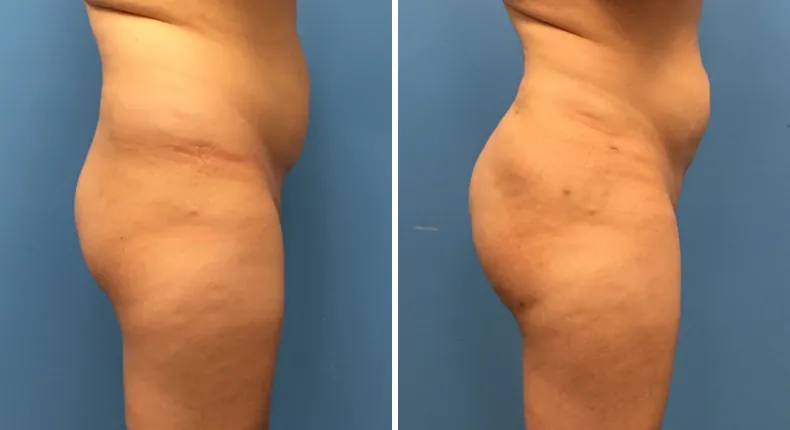 Before and after brazilian butt lift (bbl): patient's buttocks and hips from the right side
