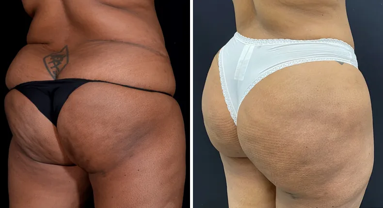 Before and after brazilian butt lift (bbl): patient's buttocks and hips at a right angle