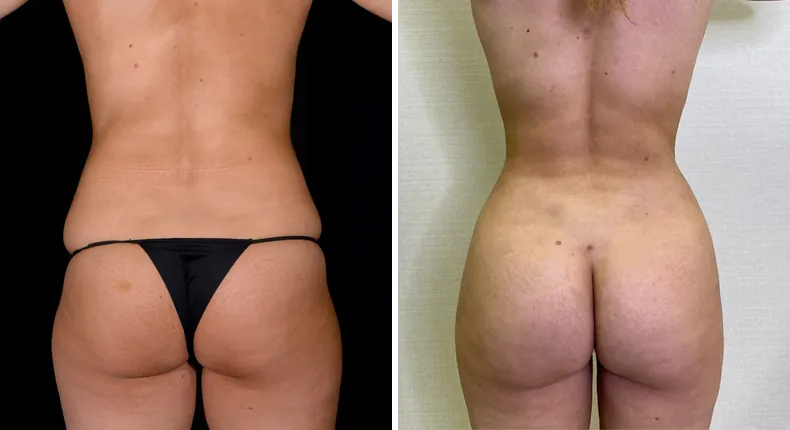 Before and after brazilian butt lift (bbl): patient's buttocks and hips from the back, with liposuction