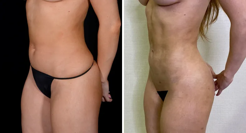 Before and after brazilian butt lift (bbl): patient's buttocks and hips at a left angle, with liposuction