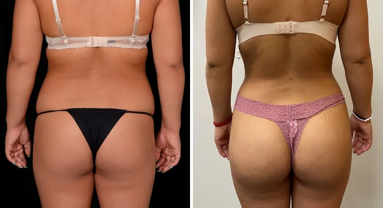 Before and after brazilian butt lift (bbl): patient's buttocks and hips