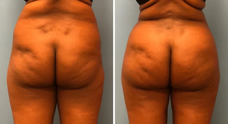 Before and after brazilian butt lift (bbl): patient's buttocks and hips from the front
