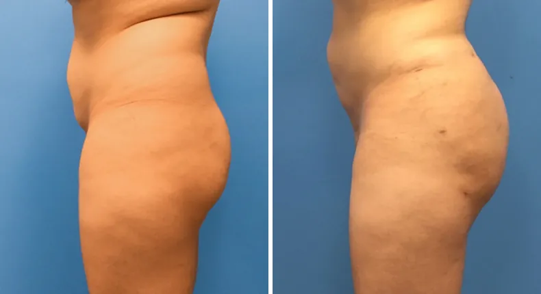 Before and after brazilian butt lift (bbl): patient's buttocks and hips from the left side