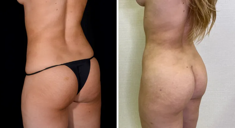 Before and after brazilian butt lift (bbl): patient's buttocks and hips at a left angle, with liposuction