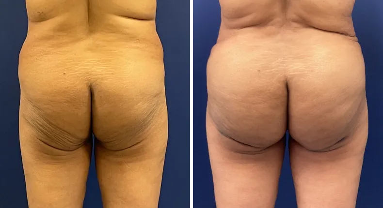 Before and after brazilian butt lift (bbl): woman's buttocks and hips