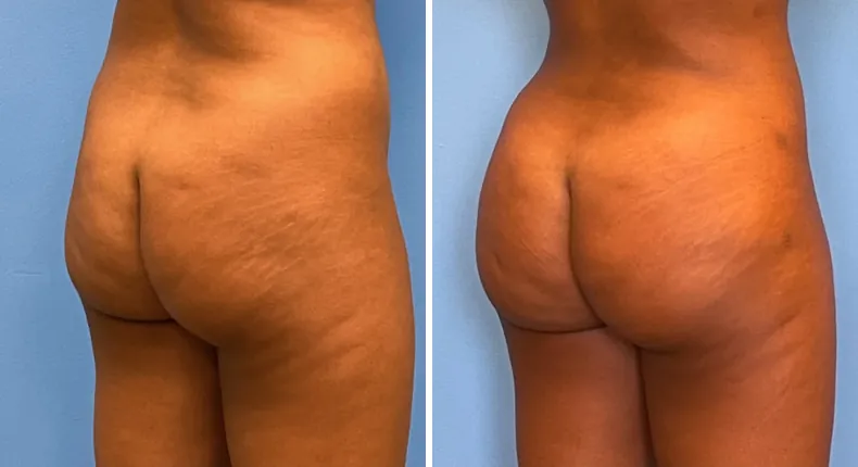 Before and after brazilian butt lift (bbl): patient's buttocks and hips at a right angle