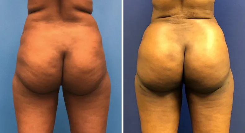 Before and after brazilian butt lift (bbl): patient's buttocks and hips