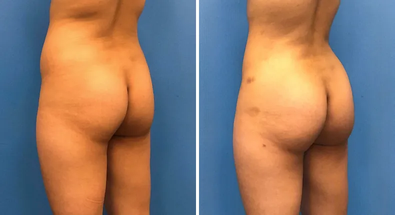 Before and after brazilian butt lift (bbl): patient's buttocks and hips at a left angle