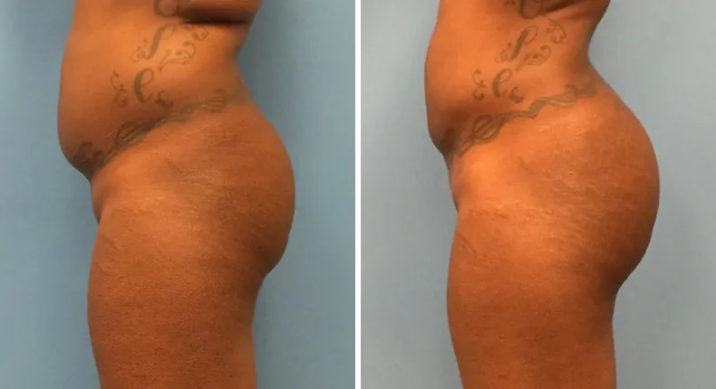 Before and after brazilian butt lift (bbl): woman's buttocks and hips from the left side
