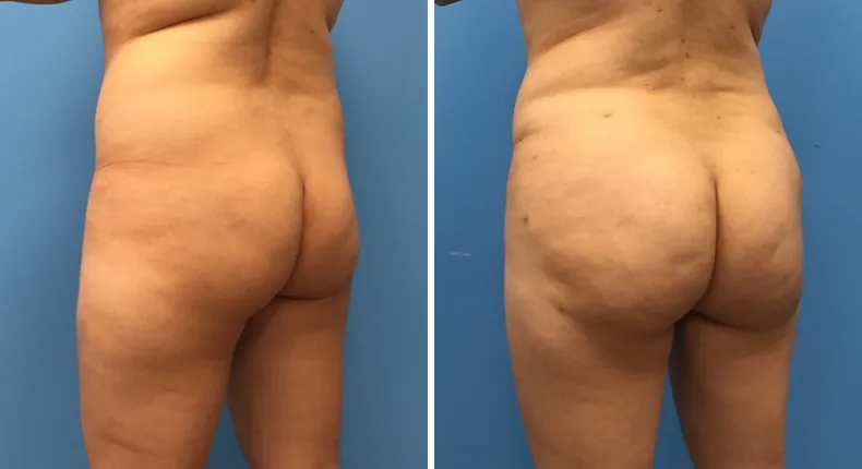 Before and after brazilian butt lift (bbl): patient's buttocks and hips at a left angle