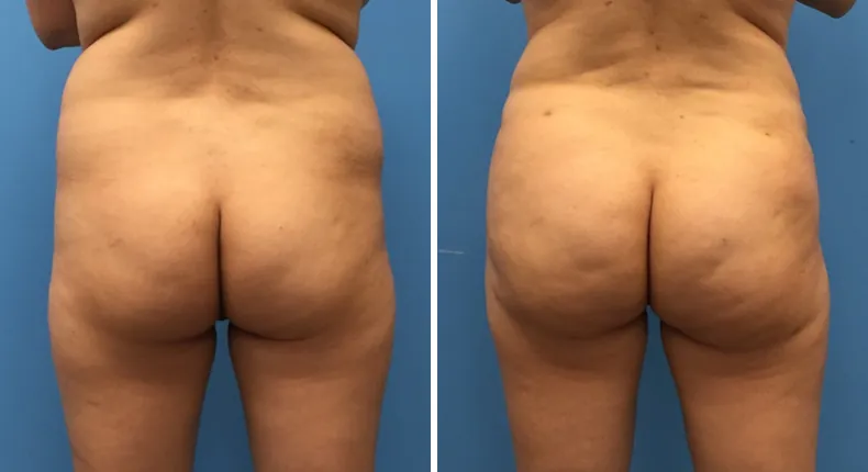 Before and after brazilian butt lift (bbl): patient's buttocks and hips from the back