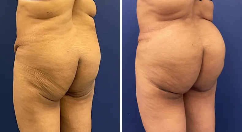 Before and after brazilian butt lift (bbl): woman's buttocks and hips at a left angle