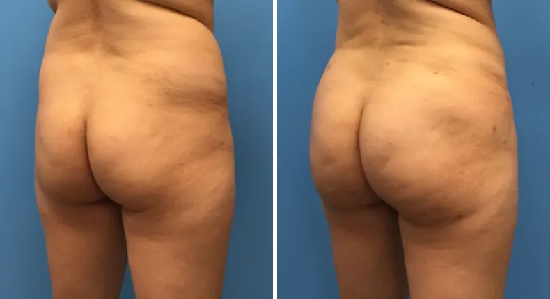 Before and after brazilian butt lift (bbl): patient's buttocks and hips at a right angle