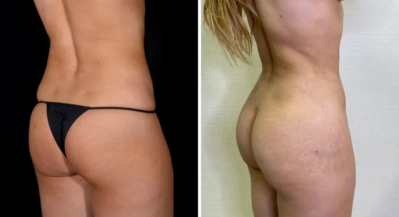 Before and after brazilian butt lift (bbl): patient's buttocks and hips at a right angle, with liposuction