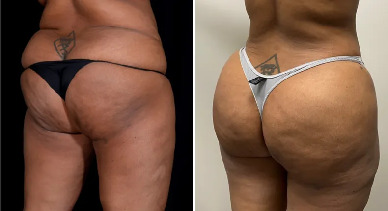 Before and after brazilian butt lift (bbl): patient's buttocks and hips at a right angle