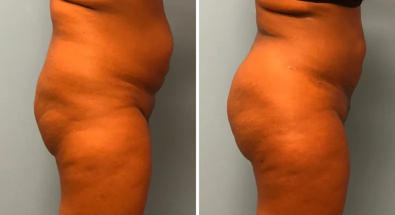 Before and after brazilian butt lift (bbl): patient's buttocks and hips from the right side