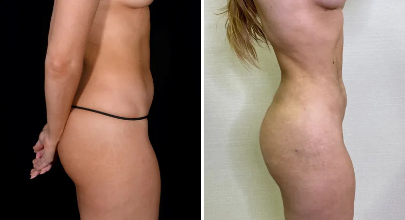 Before and after brazilian butt lift (bbl): patient's buttocks and hips from the right side, with liposuction