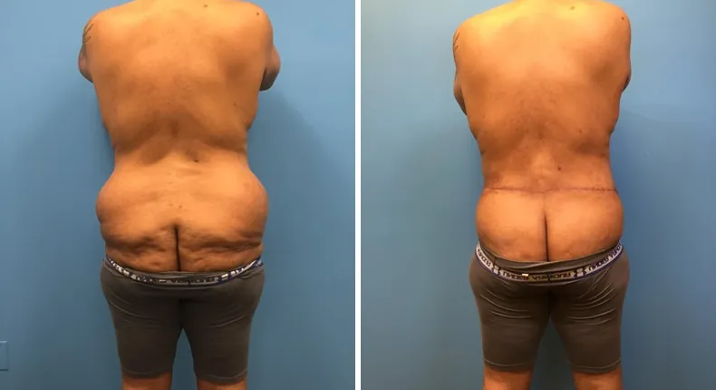 Before and after body lift: patient's body