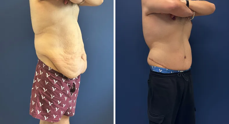 Before and after body lift: man's body