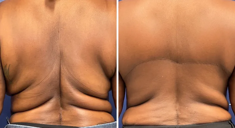 Before and after body lift: patient's body