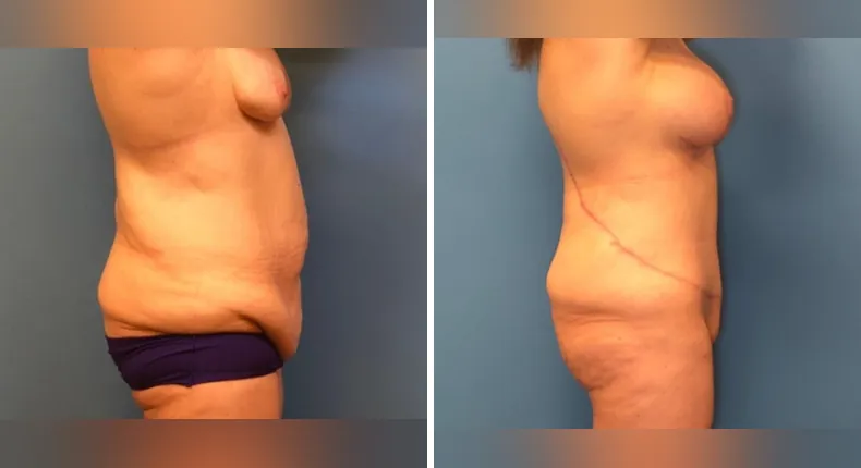Before and after body lift: patient's body