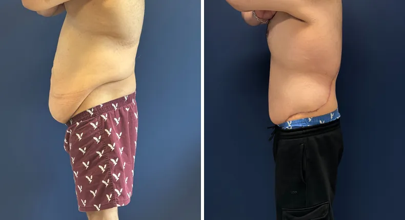 Before and after body lift: man's body