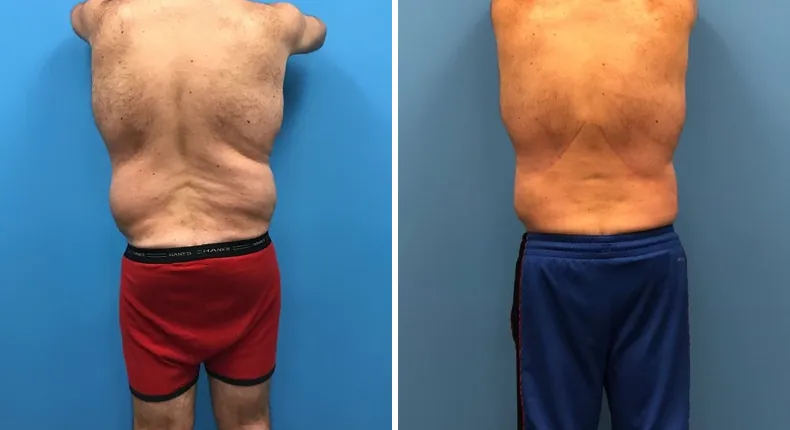 Before and after body lift: man's body from the back