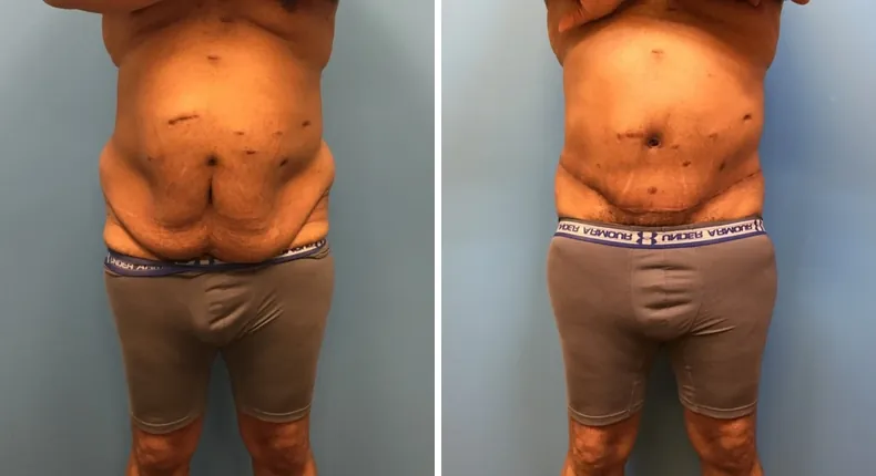 Before and after body lift: patient's body