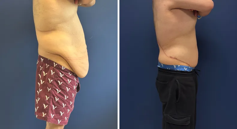 Before and after body lift: man's body